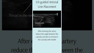 USguided Arterial Line Placement arteriallineciriticalcare USguidance [upl. by Yddub]