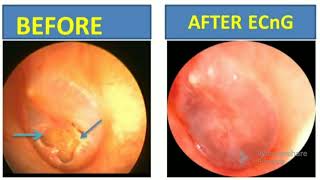 Ear drum perforation hearing loss Tinnitus recovered with in a week of treatment [upl. by Ainnet]