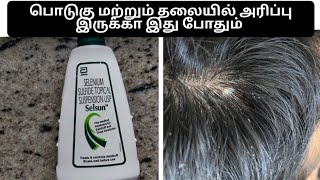 selsun shampoo for dandruff review in tamil  anti dandruff shampoo itchy scalp [upl. by Stutman673]