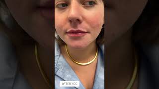 Lip fillers over time Skin Tightening Botox and Lip Fillers by Skinsation LA [upl. by Wolbrom745]