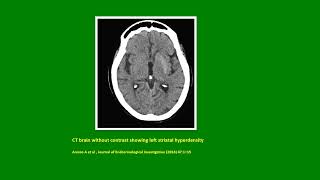 Neurology Quiz 84 Diabetic Striatopathy [upl. by Bounds]