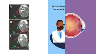 Aqueous humour outflow imaging seeing is believing [upl. by Aniv]