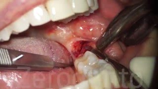 Horizontal Impacted Wisdom Tooth  Sonic Surgery  Dr Fabio Cozzolino  Zerodonto [upl. by Otsugua]