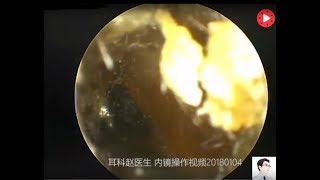 Earwax Removal Extractionoil ears small lumps dry pick 12 minutes [upl. by Aratahc322]