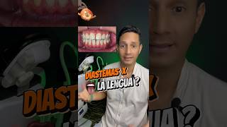 Diastemas por culpa de la LEMGUA 😛 brackets ortodoncia diastema [upl. by Oker]