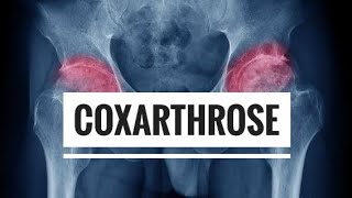 LArthrose  partie 03 Coxarthrose [upl. by Prebo]