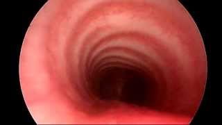 Normal Airway Endoscopy Examination  Paediatric ENT Consultant London  ENT Surgery London [upl. by Atteoj]