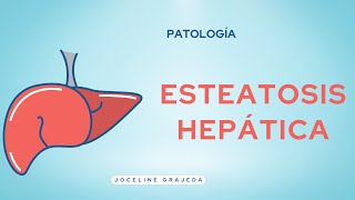 Esteatosis Hepática  Patología [upl. by Ainek]