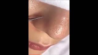 blackhead remover [upl. by Shafer]