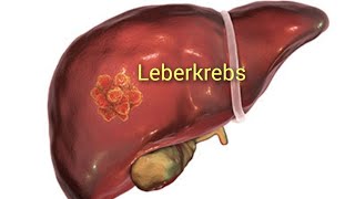 Leberkrebs Ursachen Risikofaktoren Symptome Diagnose und Therapie [upl. by Plafker]