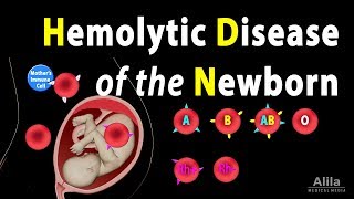 Hemolytic Disease of the Newborn HDN Animation [upl. by Airdnaz]