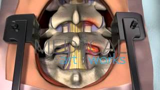 3D Medical Animation  Lumbar spine surgical procedure 2 level fusion of L4S1 [upl. by Yrogerg]