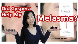 Did Cyspera® Help My Melasma My Results [upl. by Emili]