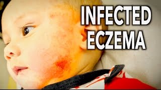 CUTE BABY with INFECTED RASH Eczema  Dr Paul [upl. by Opportina943]