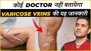 Real Information About Varicose Veins Treatment That No Doctor Will Tell You  Dr Gaurav IR [upl. by Naxela]