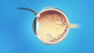 Macular Hole Vitrectomy Surgery [upl. by Kenrick]