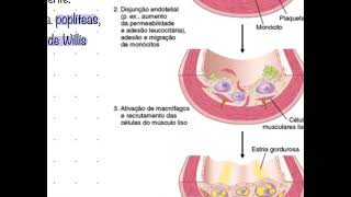 Aterosclerose [upl. by Estrellita]