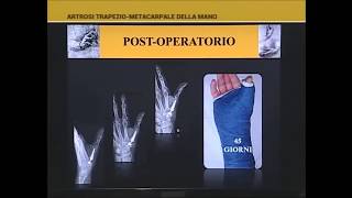 ARTROSI DELLA MANO RIZOARTROSI E PROTESI DI POLLICE By DR MARCELLO STAMILLA [upl. by Dedra]