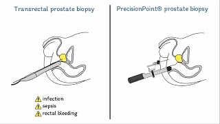 Prostate Biopsies Explained Transrectal vs PrecisionPoint® [upl. by Pul348]