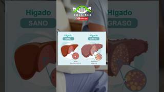 ESTEATOSIS HEPATICA en 1Min salud medicina medico saludable [upl. by Aikar983]