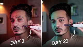 My Scar’s Journey with Dermapen at Home [upl. by Caneghem215]