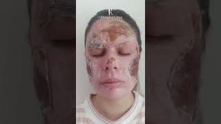 Peeling de Fenol para cicatrizes de acne [upl. by Kitti]