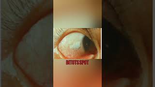 Bitots spot Dry eyevitamin A ki kami [upl. by Hadihsar]