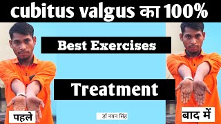 cubitus valgus bilateral treatment in hindi cubitus valgus vs varus  physiotherapy exercises [upl. by Waldron]