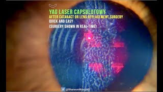 Everything you need to know about YAG LASER Capsulotomy in 30 seconds [upl. by Cofsky564]