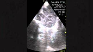 VSCAN Retroperitoneal lymphadenopathy AdenopatiÌas retroperitoneales [upl. by Karlis]