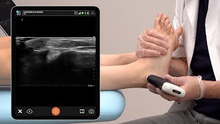 Ultrasound of the Lateral Ankle Ligaments [upl. by Ayal]