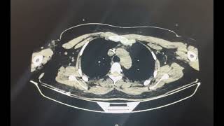 Angiotomografia toracico por operculo toracico arterial [upl. by Ymmik]