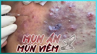 Big Cystic Acne Blackheads Extraction Blackheads amp Milia Whiteheads Removal Pimple Popping [upl. by Eidissac324]