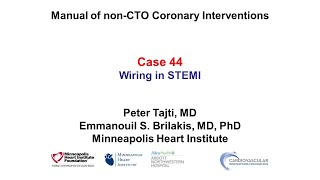 Case 44 PCI Manual  Wiring in STEMI [upl. by Matthia]