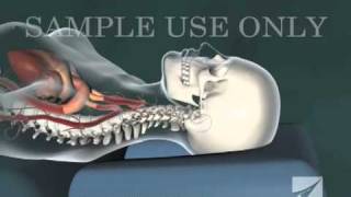 Cervical Chiropractic Adjustment [upl. by Yerd]