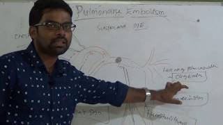 PULMONARY THROMBOEMBOLISM [upl. by Anaig]