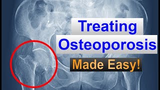 OSTEOPOROSIS Medications Made EASY [upl. by Epilihp]