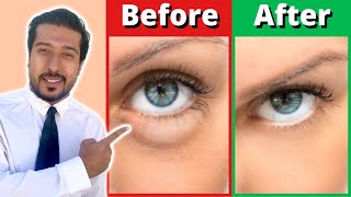 How to Get Rid of Puffy Eyes and Bags in 5 Fast Steps [upl. by Cal]