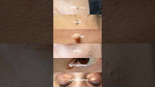 Tahu lalat  kutil  skin tag  milia  syringoma bisa diatasi dgn treatment inj pesonaayu [upl. by Patrice]