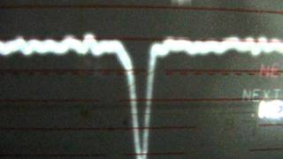 Laserdisc performance modifications  Overshoot  ringing [upl. by Mahon]