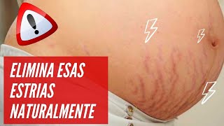 🤰 Como Eliminar las Estrías Rojas del Embarazo  Estoy Embarazada y Tengo Estrias 😱 [upl. by Olram]