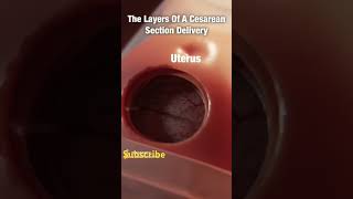 Beautiful Breech C Section Delivery 40 weeks 10day pregnancy 🤱shots [upl. by Peg]