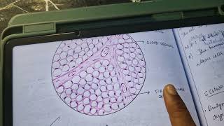 lipoma histopathology [upl. by Zobkiw]