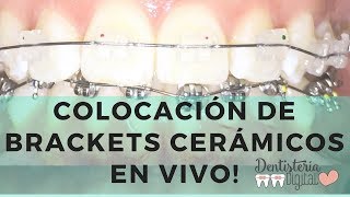 Colocación de Brackets Cerámicos EN VIVO  Ceramic Braces putting on  LIVE [upl. by Anitak]