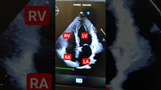 apical 4 chamber  A4C view  echocardiography  echocardiogram  echo [upl. by Heater]