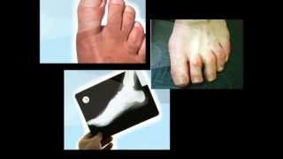 How to Fix Hammer Toe On Children [upl. by Schlosser768]