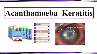 Acanthamoeba Keratitis [upl. by Bertolde]