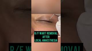 Wart removal on Eyelidhow to get rid of wartsDermatologist in Chandigarh Dr Ashima Goel Mohali [upl. by Aisul399]