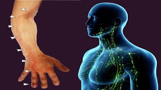 Lymphangitis Causes And Symptoms [upl. by Naujad]