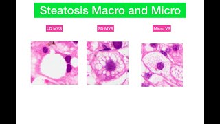 Macro and microvesicular steatosis in liver [upl. by Ysnil]